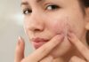 Top 5 Ways to Conquer Cystic Acne Cystic Acne