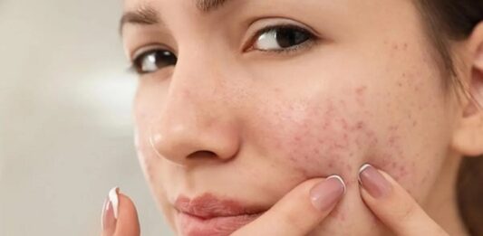 Top 5 Ways to Conquer Cystic Acne Cystic Acne