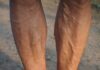 The Primary Predisposing Factors to Varicose Veins Varicose Veins