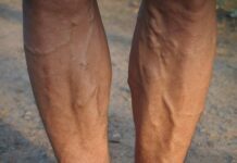 The Primary Predisposing Factors to Varicose Veins Varicose Veins