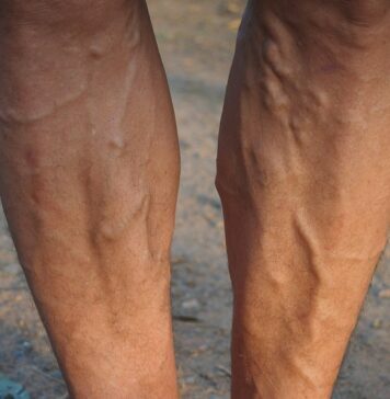 The Primary Predisposing Factors to Varicose Veins Varicose Veins